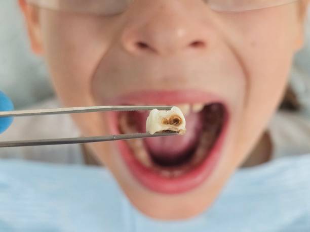 Best Knocked-Out Tooth (Avulsed Tooth) Treatment in Eyota, MN
